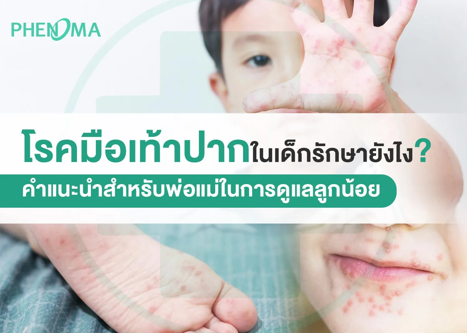 โรคมือเท้าปาก